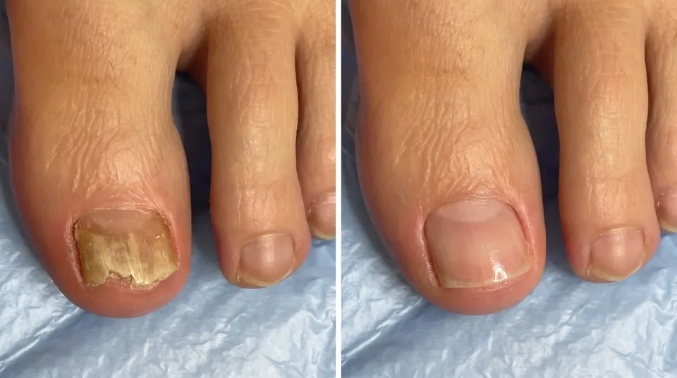 Side-by-side view of a fungal toenail before treatment and a clearer-looking nail afterwards