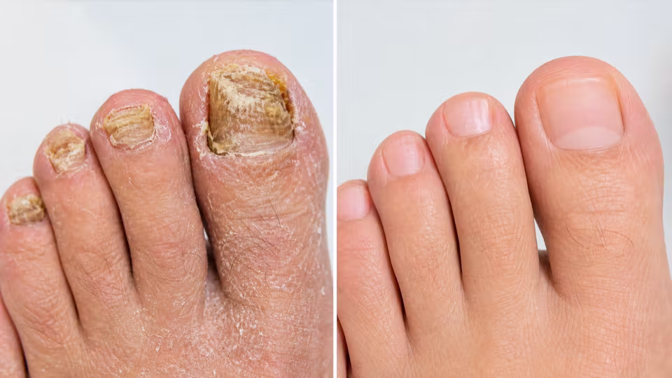 Initial fungal nail appointment